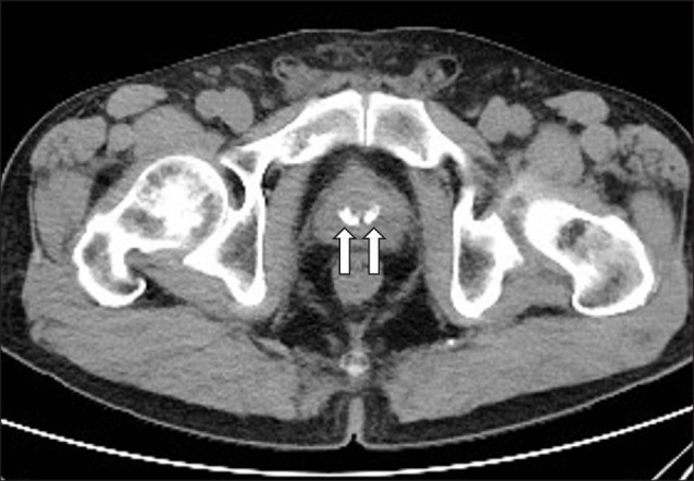 Sỏi tuyến tiền liệt trên CT Scanner