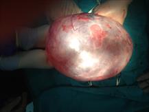 Phẫu thuật nội soi cắt buồng trứng