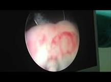 Diagnosis and treatment: Endoscopic surgery  of Ureterocele