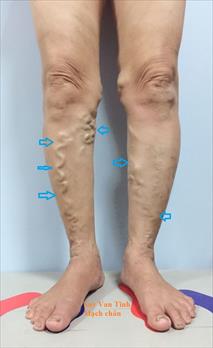 Chẩn đoán suy van tĩnh mạch hiển- giãn tĩnh mạch ở chân