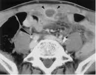 CT Scanner - urachal cyst