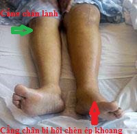 Hội chứng chèn ép khoang cẳng chân