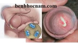 Chảy mủ - lậu/benhhocnam.com