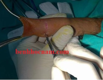 Bao quy đầu dài/benhhocnam.com