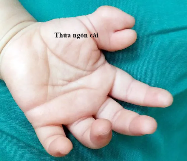 Thừa ngón cái/benhhocnam.com