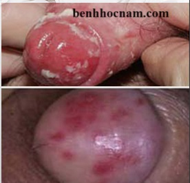 Quy đầu viêm đỏ/benhhocnam.com