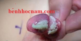 Cặn trắng bao quy đầu trẻ em/benhhocnam.com