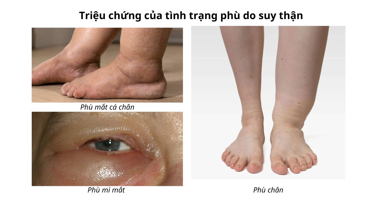 Biểu hiện suy thận