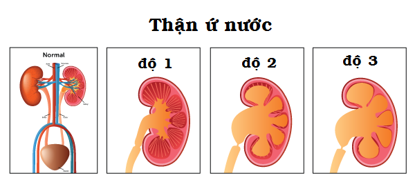 các mức độ ứ nước thận/benhhocnam.com