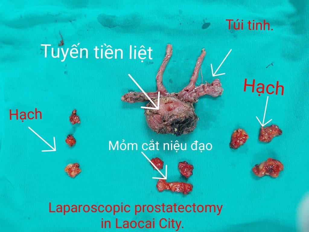 Toàn bộ tuyến tiền liệt - túi tinh và hệ thống hạch chậu. Benhhocnam.com