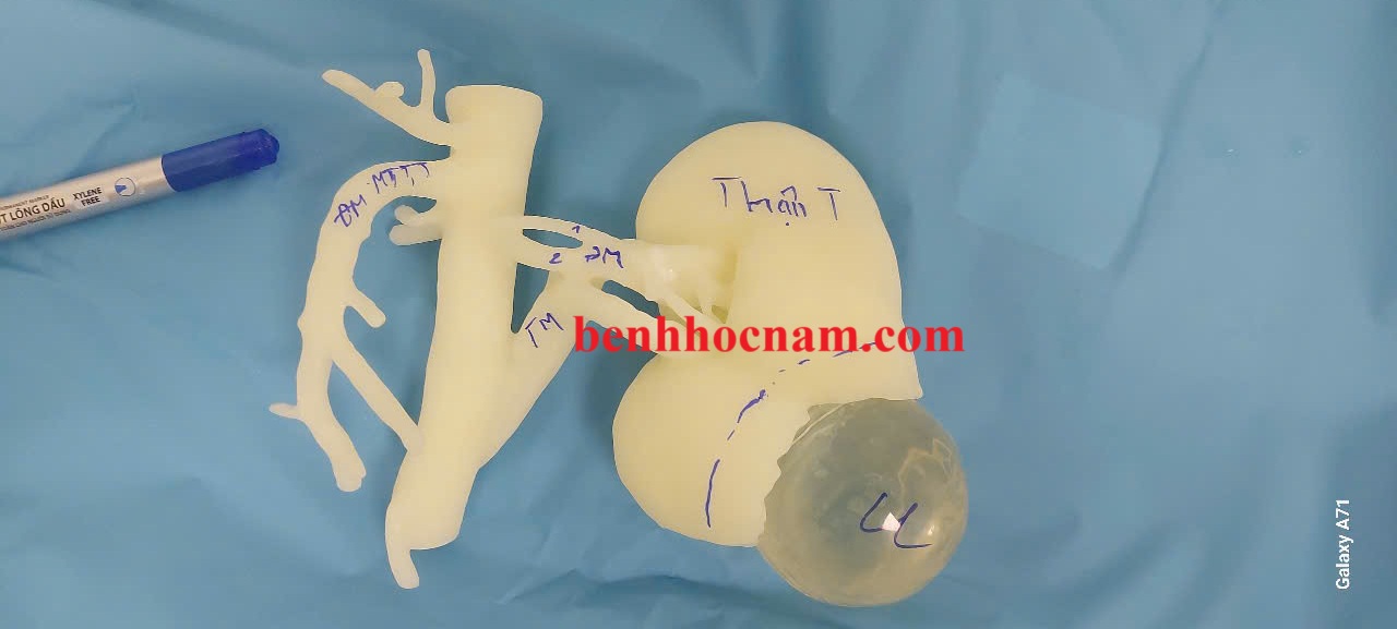 thận và khối u in 3D - benhhocnam.com