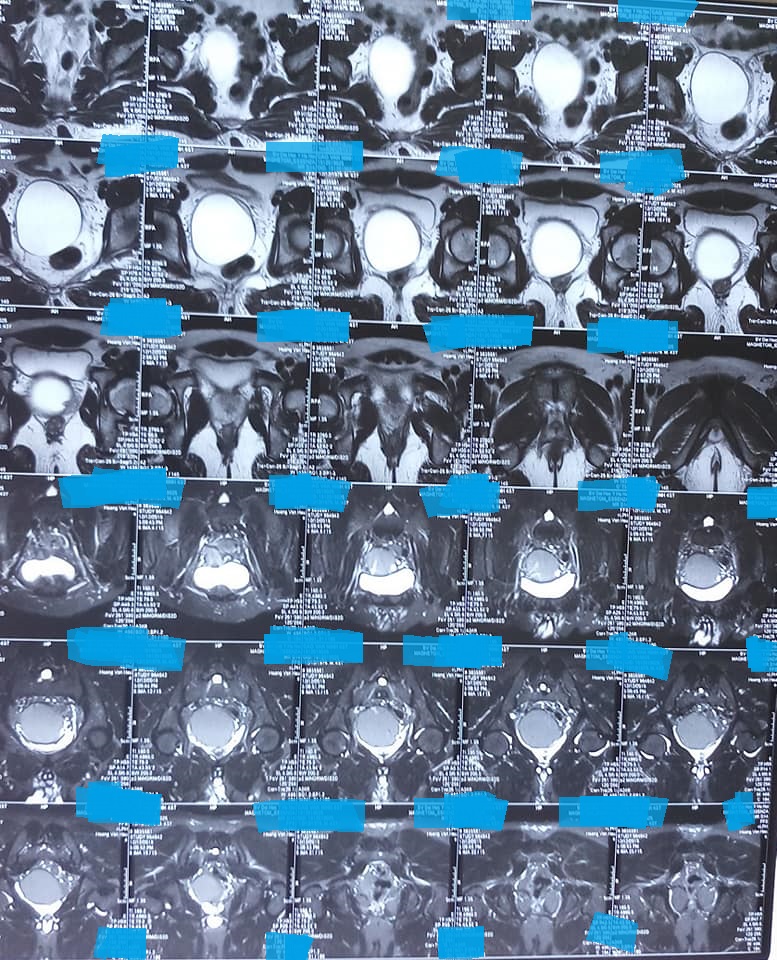 Hình ảnh MRI của nang Muller/benhhocnam