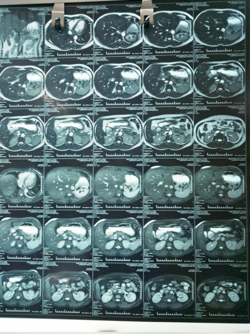 MRI u tuyến thượng thận trái/benhhocnam.com