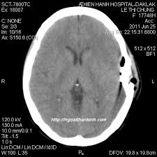 Vết thương sọ não hở trên CT Scanner