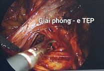Triển khai kỹ thuật e - TEP điều trị thoát vị bẹn