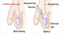 Phẫu thuật bóc nang mào tinh hoàn