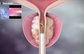 Điều trị bí đái do u tuyến tiền liệt lành tính không gây xuất tinh ngược dòng