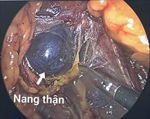 ĐÁNH GIÁ HIỆU QUẢ CỦA PHẪU THUẬT NỘI SOI CẮT CHỎM NANG THẬN TẠI BỆNH VIỆN E TỪ NĂM 2021 - 2025