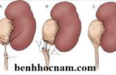 Hẹp niệu quản: Nguyên Nhân - Hậu quả - Điều trị