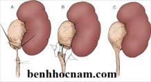 Hẹp niệu quản: Nguyên Nhân - Hậu quả - Điều trị