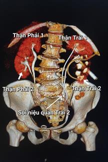 Ca lâm sàng tán sỏi nội soi cho người phụ nữ có 4 thận