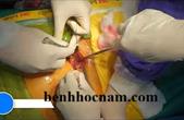 Kỹ thuật mở thông bàng quang ra da - dẫn lưu bàng quang
