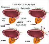 Khi bạn bị ung thư tuyến tiền liệt bạn vẫn có thể điều trị khỏi hoàn toàn