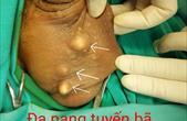 Phẫu thuật bóc đa u nang tuyến bã ở da bìu (sebaceous cyst)