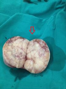 Phẫu thuật cắt tinh hoàn ung thư hóa trong ổ bụng