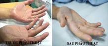 Phương pháp điều trị đổ mồ hôi, ra mồi hôi tay (Hyperhidrosis)