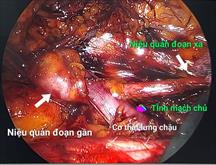 Phẫu thuật nội soi sau phúc mạc tạo hình niệu quản sau tĩnh mạch chủ dưới ( Retrocaval ureter, Laparoscpic Extraperitoneal)