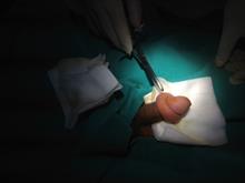 Phẫu thuật cắt da quy đầu