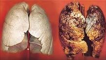 Ung thư phế quản - phổi