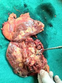 Phẫu thuật cắt thận ung thư di căn, nạo vét hạch rộng rãi