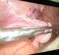 Phẫu thuật nội soi hạ tinh hoàn trong ổ bụng