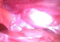 Phẫu thuật cắt tinh hoàn nội soi trong ổ bụng