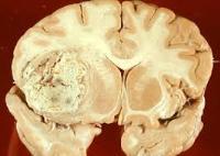 Chẩn đoán và điều trị u não