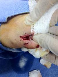 Chẩn đoán và xử trí vết thương bàn tay, bàn chân  trong tai nạn sinh hoạt