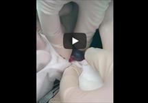 Đào tạo bóc nang mào tinh hoàn - Training about epididymal cyst excision (Spermatocele Surgery)