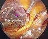 Các bước phẫu thuật nội soi sau phúc mạc cắt thận mất chức năng